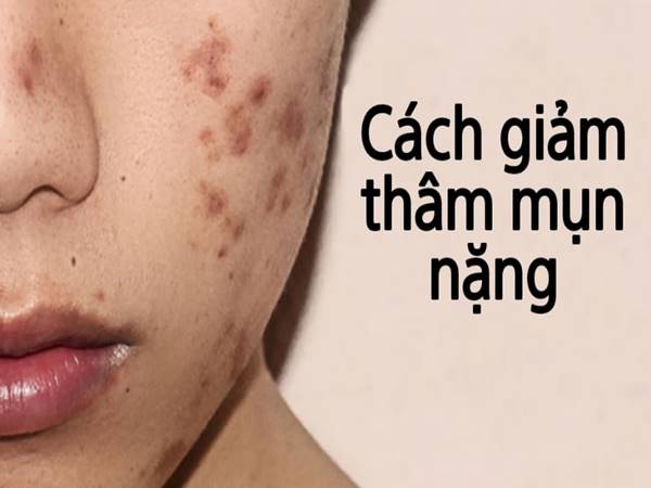 Cách trị thâm mụn nặng áp dụng được cho mọi loại da